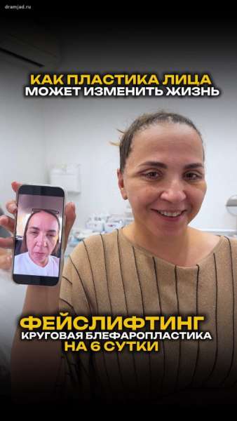 Как пластика лица может изменить жизнь. Реакция пациента на осмотре, после комплексной операции (фейслифтинг, липосакция подбородка, платизмопластика, круговая блефаропластика) на 6-е сутки